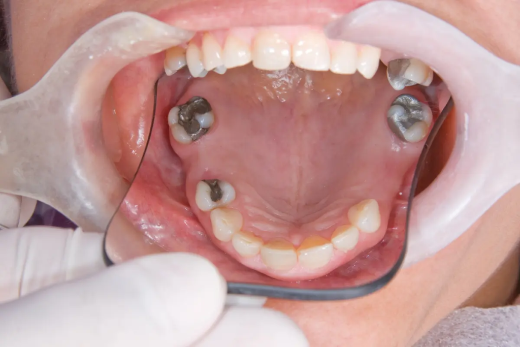 A dentist performs a full mouth reconstruction and full mouth restoration of a smile with fillings.