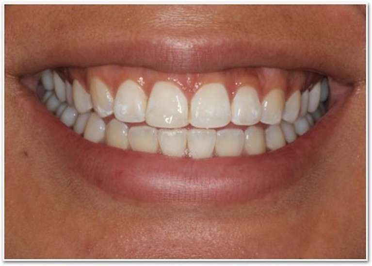 A healthy smile after receiving cosmetic procedures to add porcelain veneers VA.