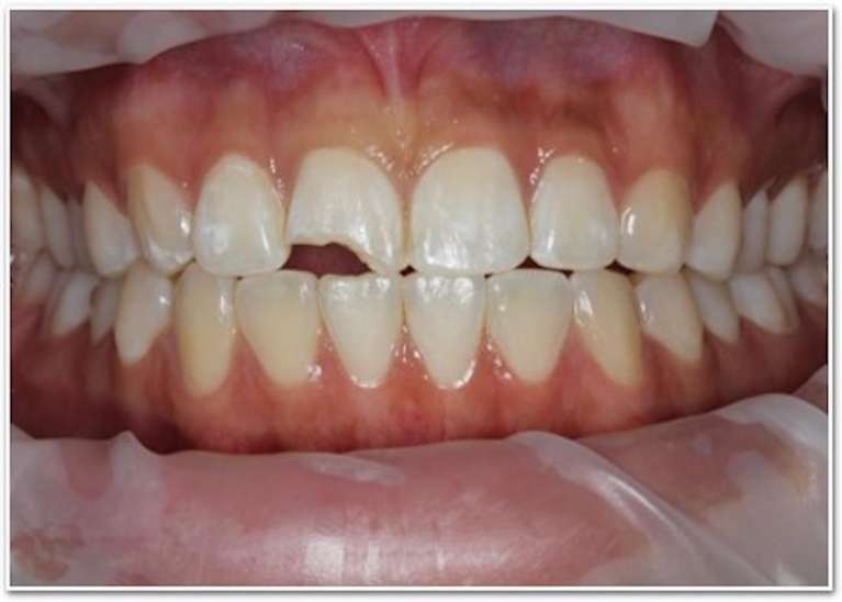 Veneers VA: Chipped teeth that sustained damage before a cosmetic dental procedure