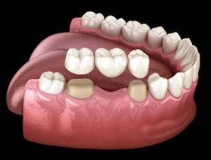 A model of a dental bridge shows how it fits in the mouth.