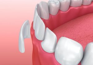 Veneers VA: Getting ceramic or porcelain veneers applies porcelain or ceramic material to a tooth.